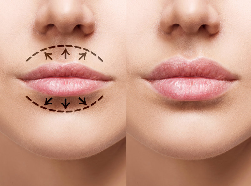 How To Make Your Lip Filler Last Longer