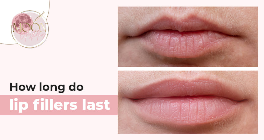 How Long Do Lip Fillers Last