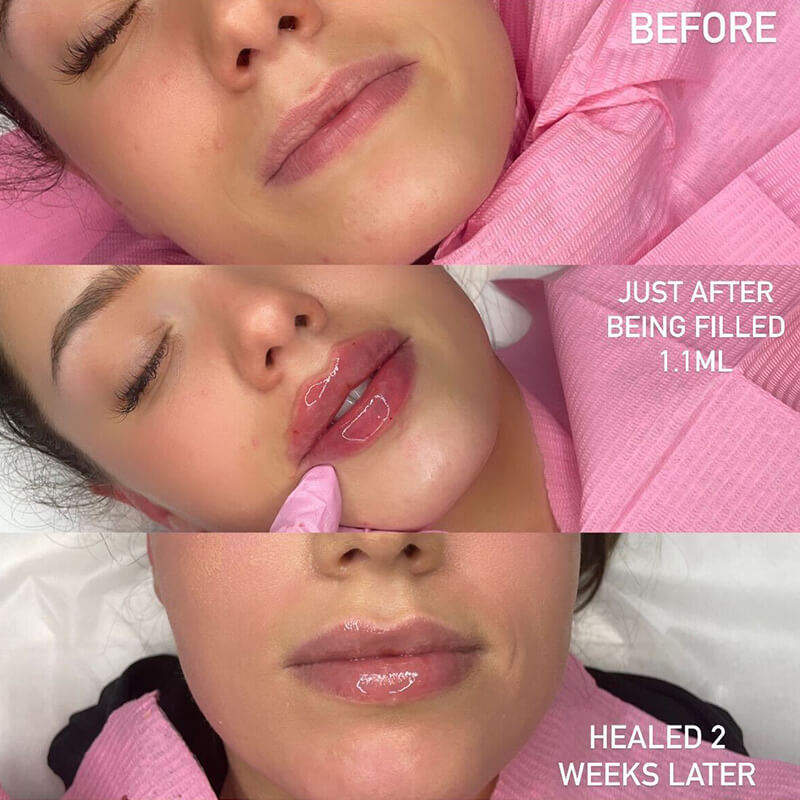 Lip Filler Swelling Before and After