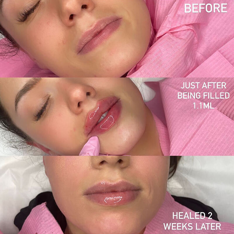 Lip Filler Swelling Stages Moon Aesthetics Blog 