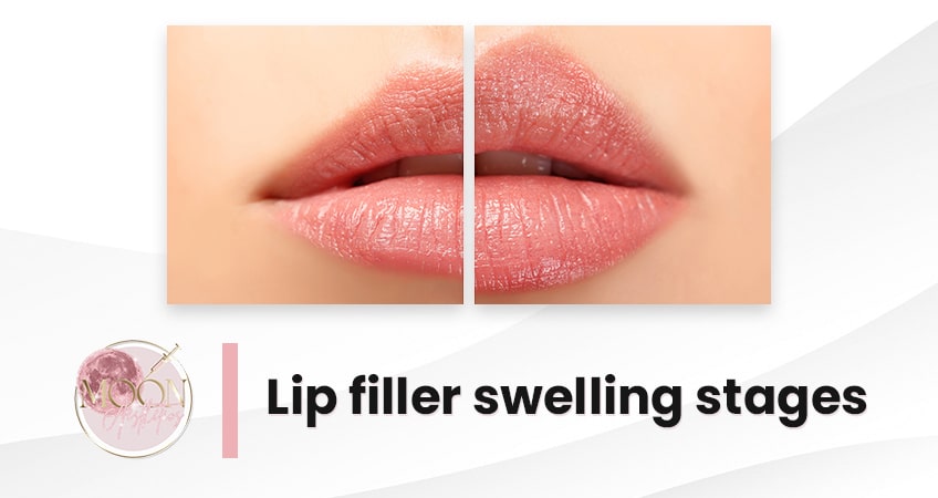 Lip Filler Swelling Stages