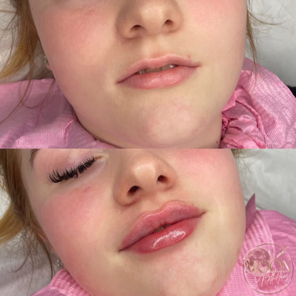 Lip Filler Swelling Process