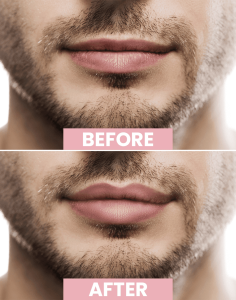 Male lip fillers