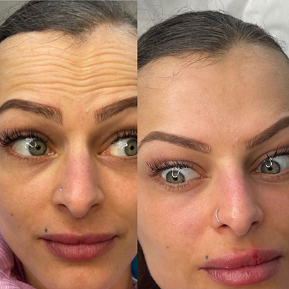 Before and after Frown lines botox Essex