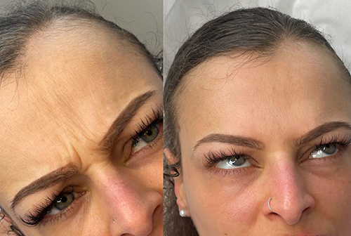 Before and after Frown lines Anti wrinkle Essex