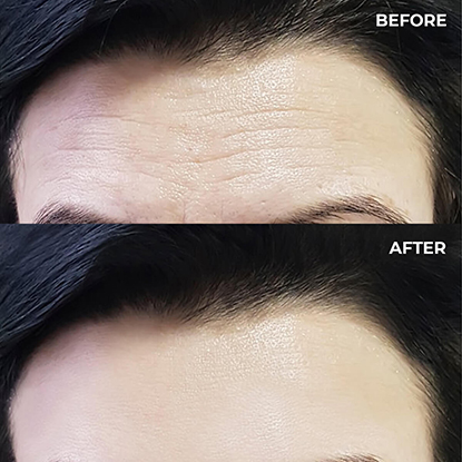 Before and after Frown lines botox Essex
