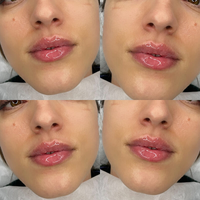 Lip Fillers Southend