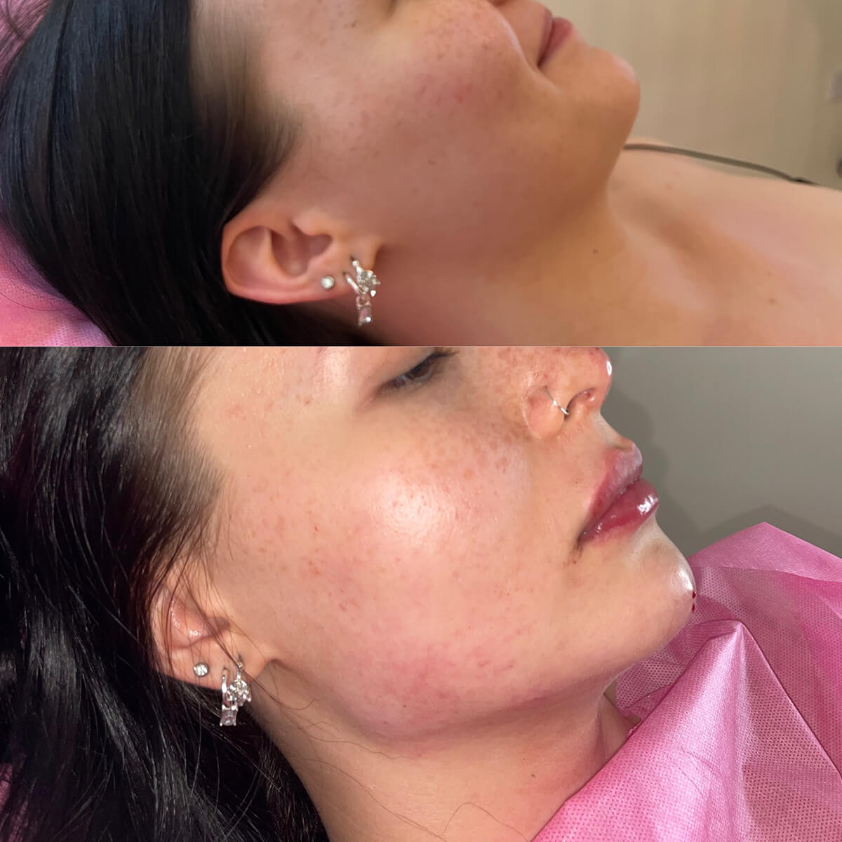 2ml Jawline fillers by moon aesthetics