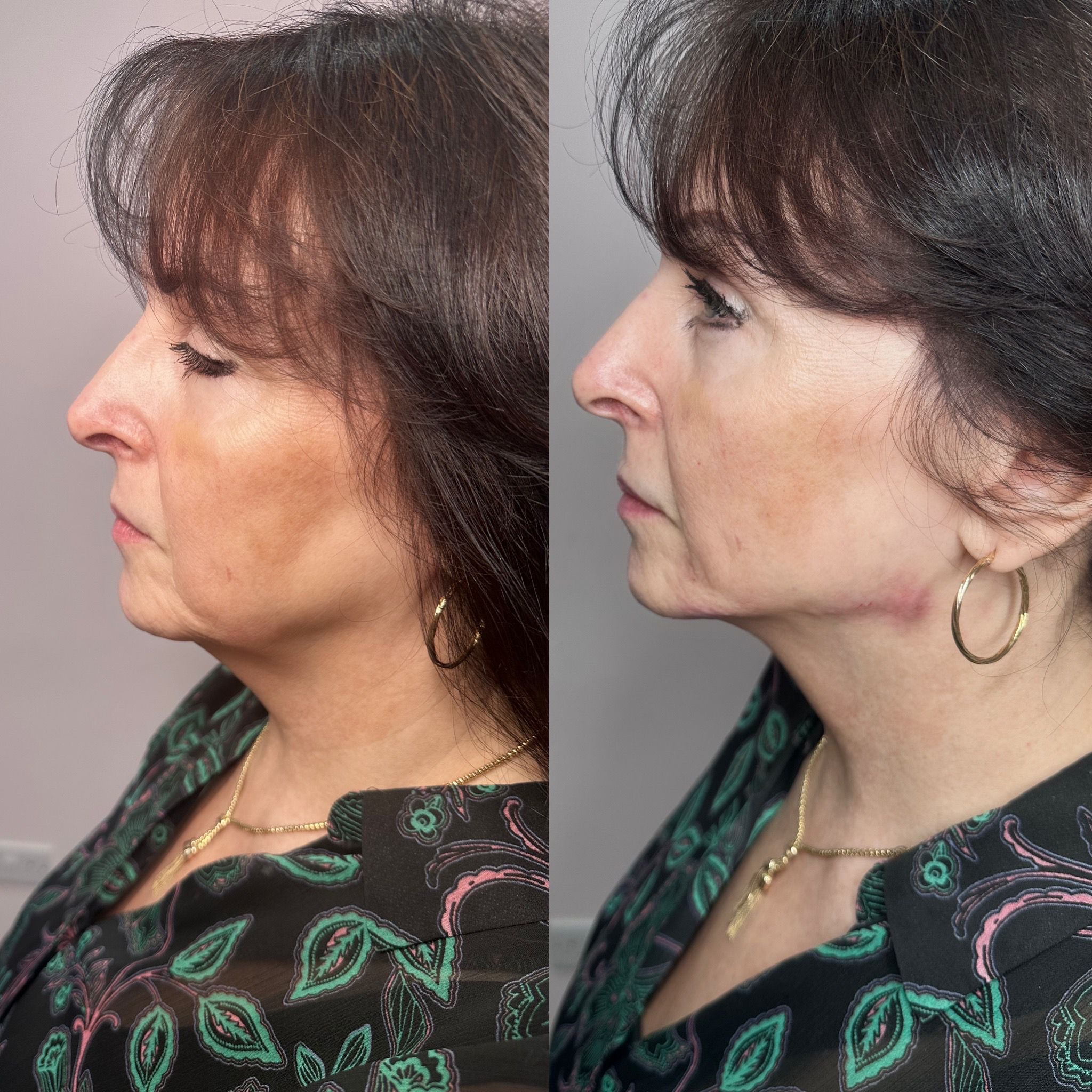 Jawline fillers experts in essex