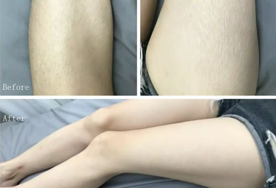 Leg hair removal by laser in Rayleigh
