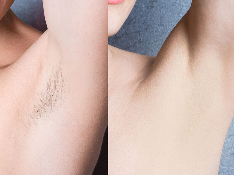 Client has hair removed from armpit using laser hair removal machine