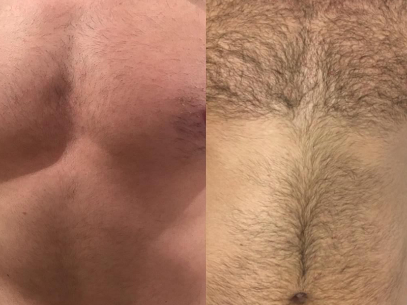 Chest and body hair removal in Rayleigh