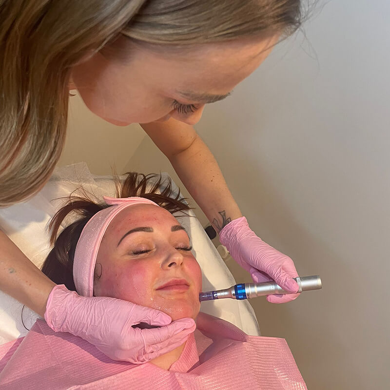 Microneedling and Bb Glow Essex