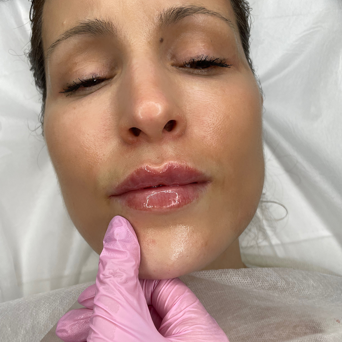Brentwood lip fillers