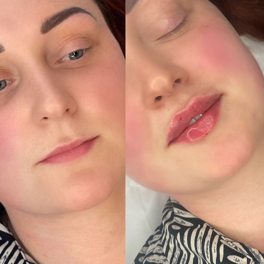 natural lip fillers brentwood