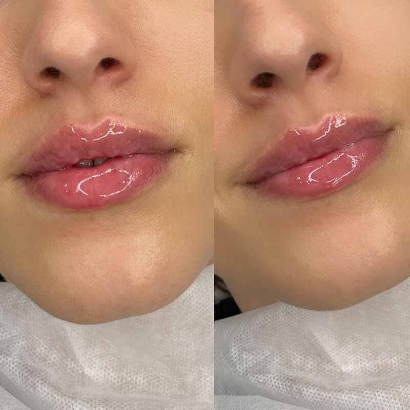 chelmsford lip fillers