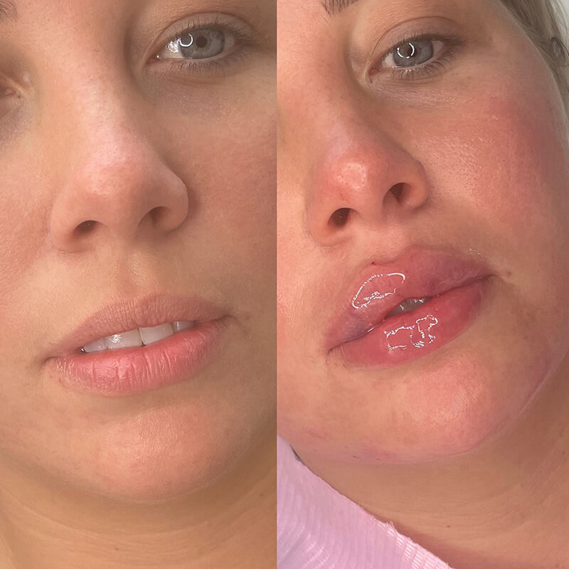 natural lip fillers chelmsford