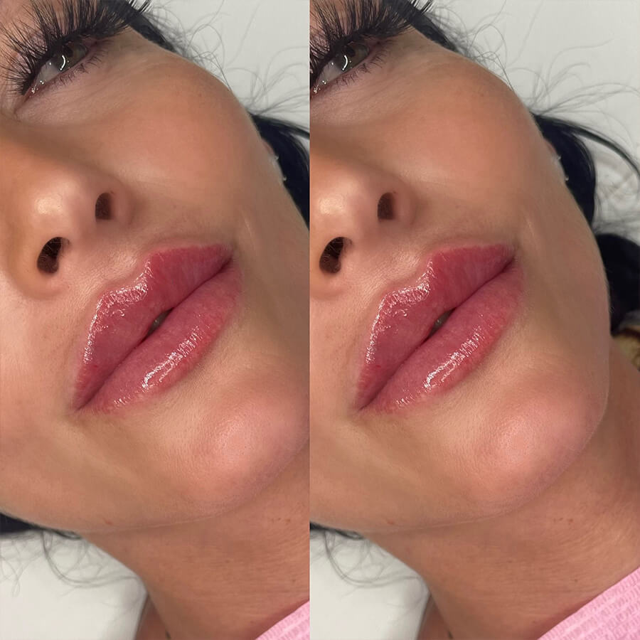 before and after lip filler treatment essex