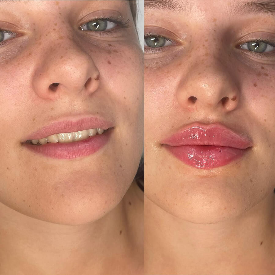 Best quality lip injections in Essex