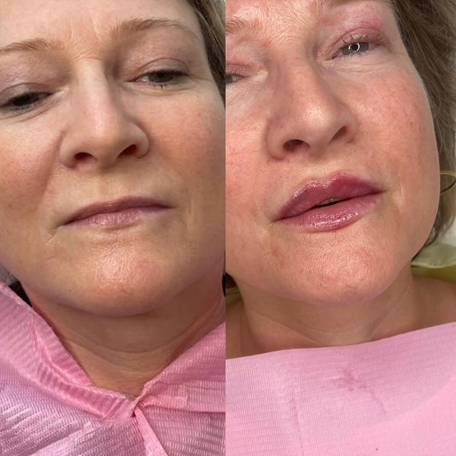 Lip filler at our clinic in Essex