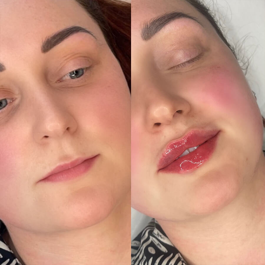 natural lip fillers Leigh on Sea