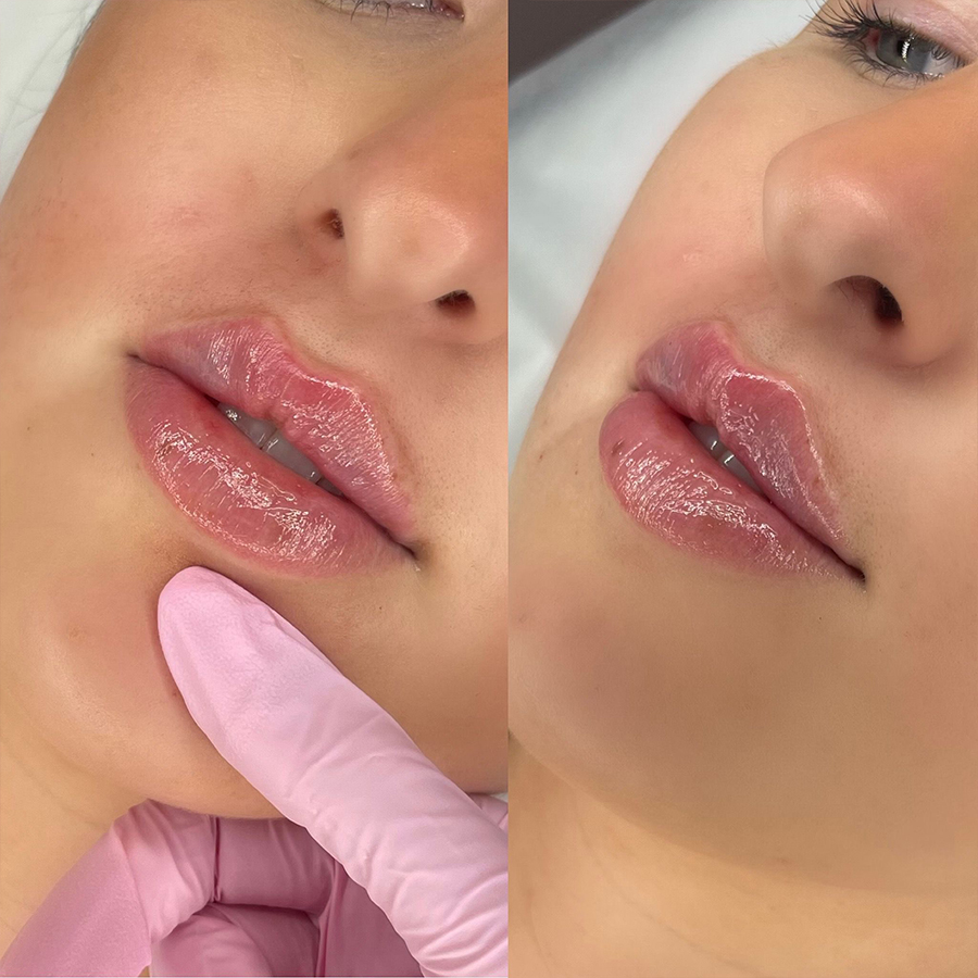 lip augmentation injections Leigh on Sea