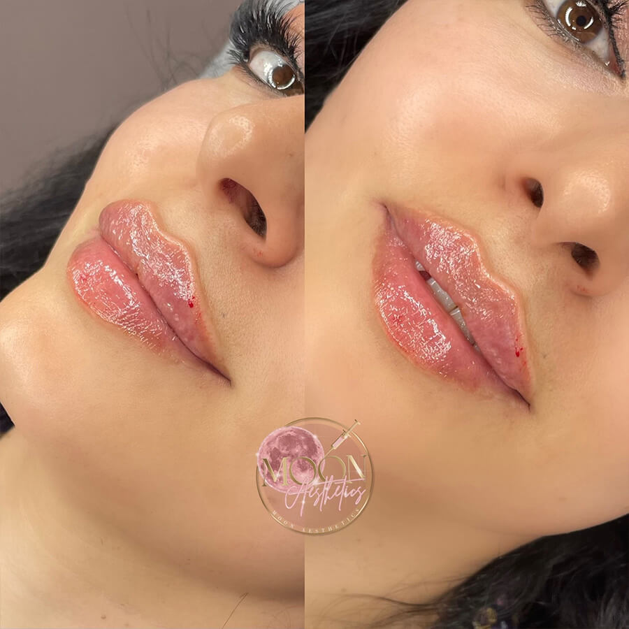 natural lip fillers Southend on Sea