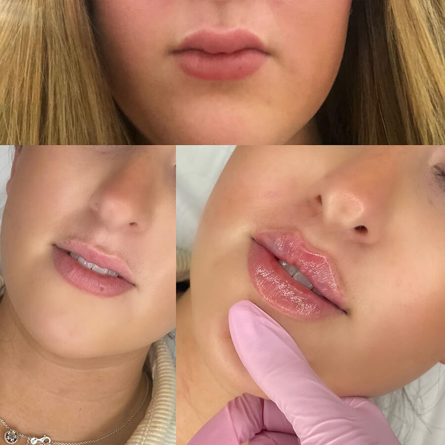 natural lip fillers Southend on Sea