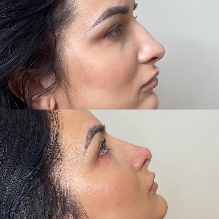 nose fillers by moon aesthetics