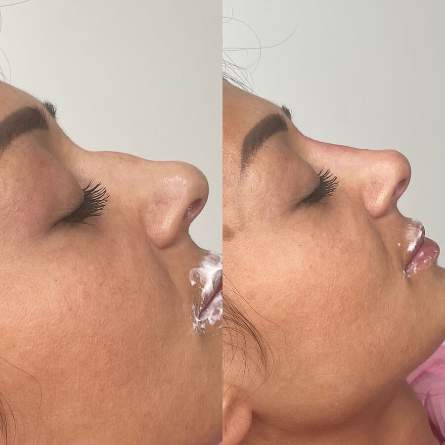 nose fillers by moon aesthetics